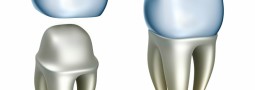 How Much Do Dental Crowns Cost?