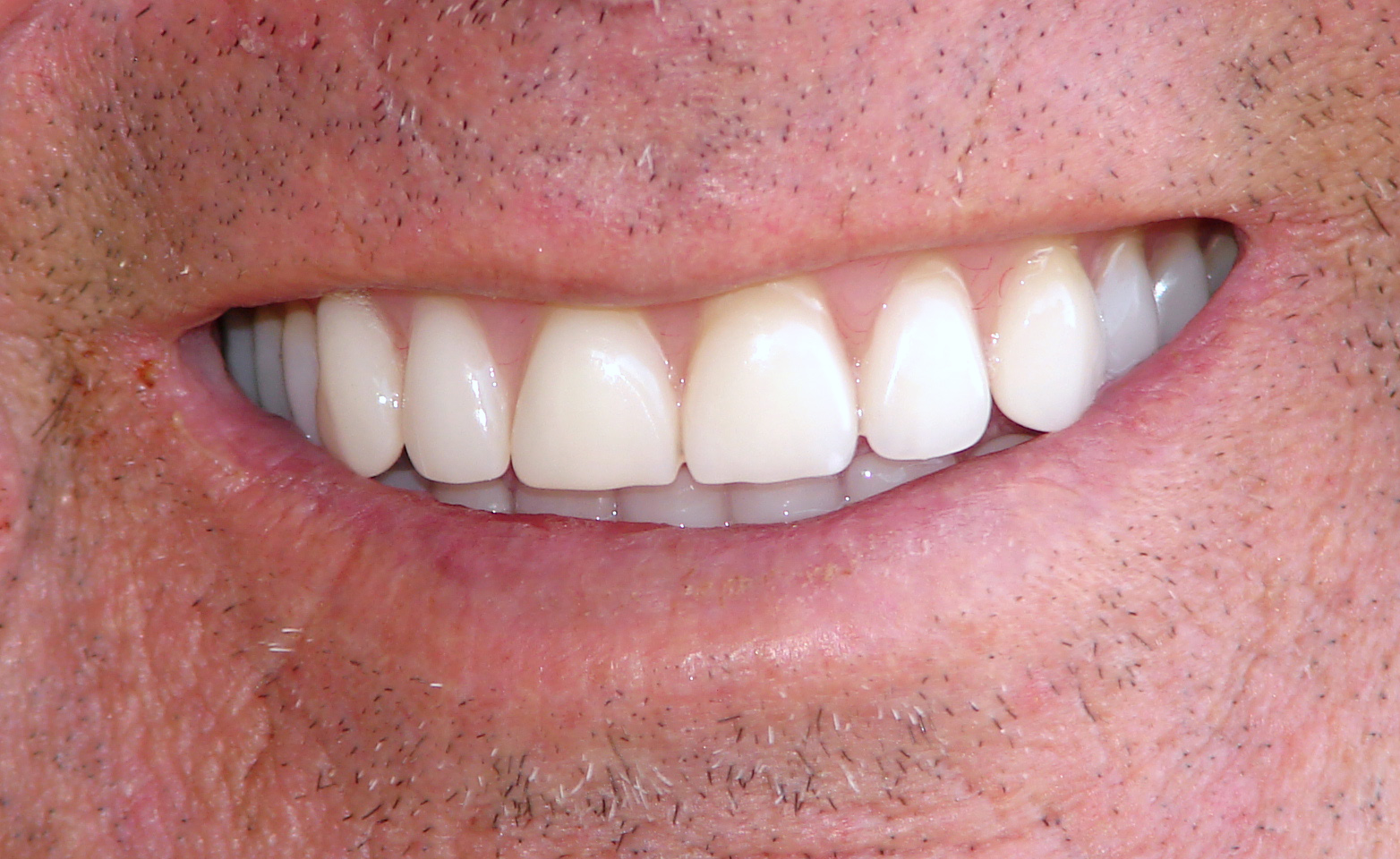 how-much-do-dentures-cost