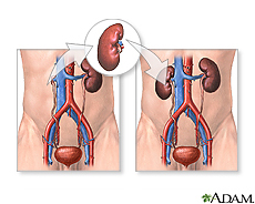 kidney transplant