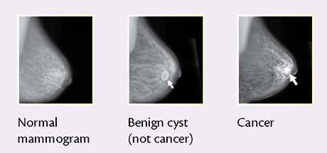 mammogram