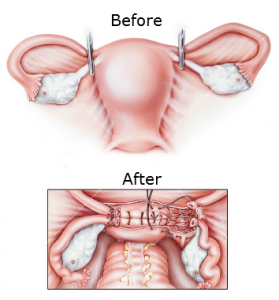 vaginal hysterectomy